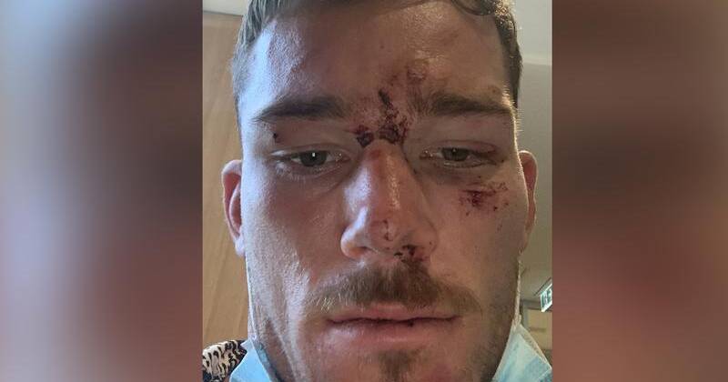Tom Starling suffered concussion and a bloodied face when allegedly assaulted by police at a bar. Photo: PR IMAGE PHOTO